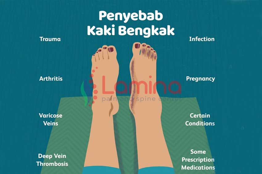 kaki bengkak pada ibu hamil