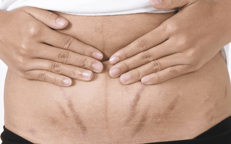 Apa itu Stretch Mark Apa Solusinnya