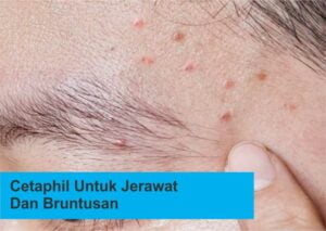 Cetaphil Untuk Jerawat Dan Bruntusan