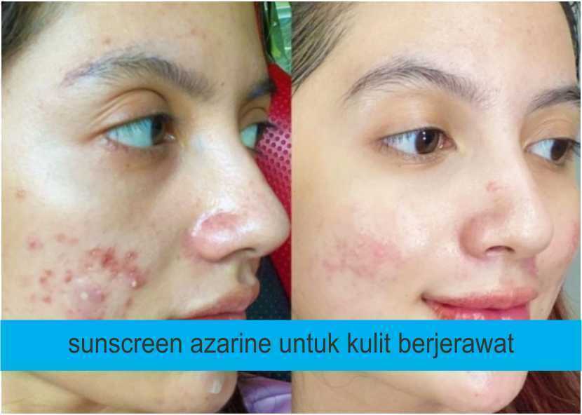 sunscreen azarine untuk kulit berjerawat
