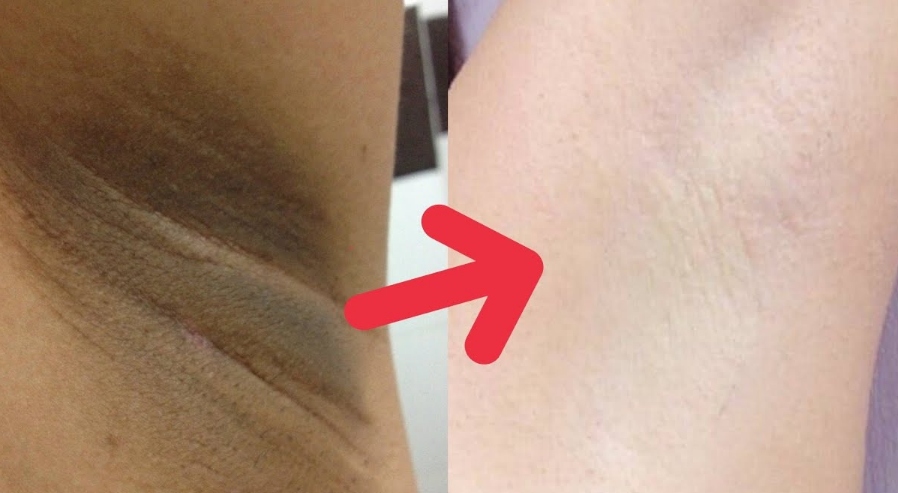 cara memutihkan selangkangan hitam dengan baby oil