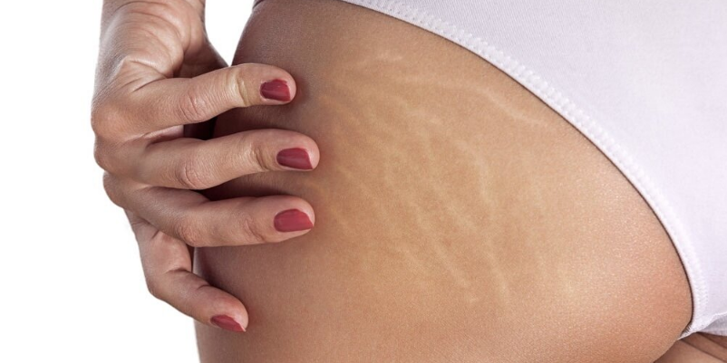 cara menghilangkan stretch mark dengan vaseline 3