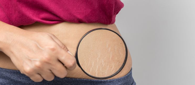 cara menghilangkan stretch mark dengan vaseline