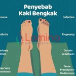 kaki bengkak pada ibu hamil