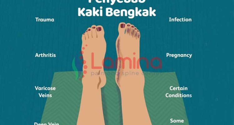 kaki bengkak pada ibu hamil