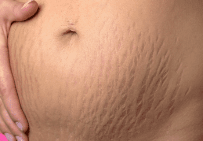 Apa itu Stretch Mark Apa Solusinnya 2