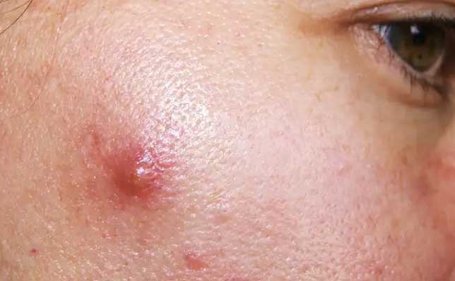 Kista Jerawat Cystic Acne